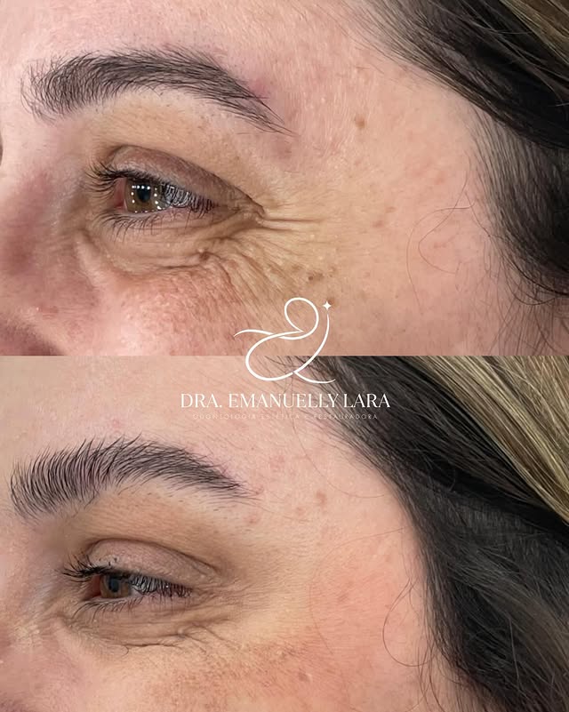 Antes e depois de tratamento na região dos olhos